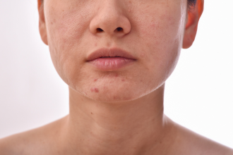 Peau mixte : le guide complet pour équilibrer, hydrater et sublimer votre visage