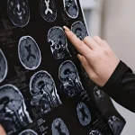 alzheimer