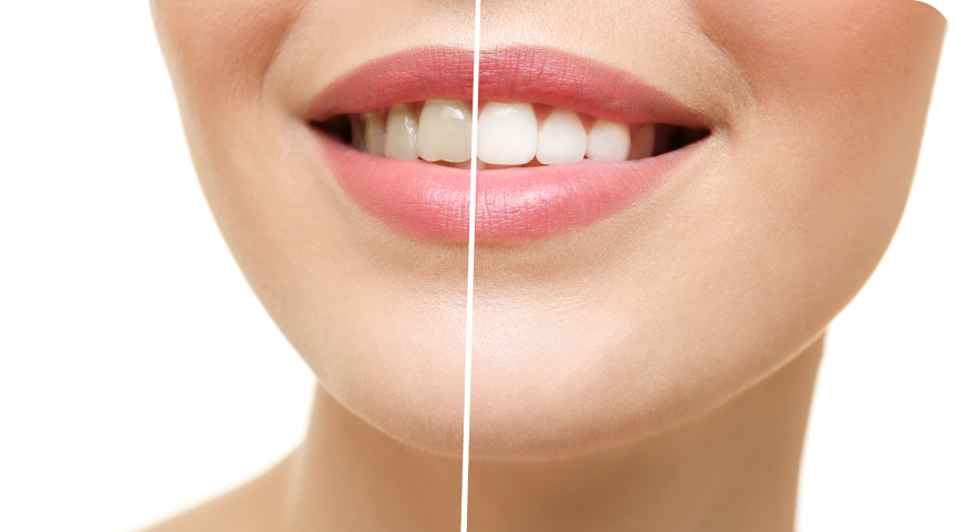Dents blanches naturellement