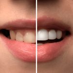 Blanchir dents