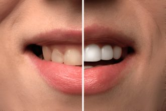 Blanchir dents