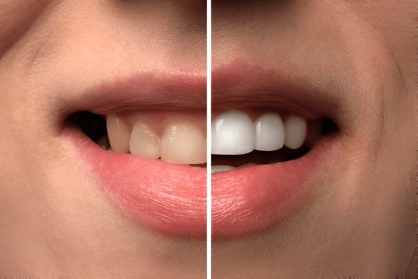 Blanchir dents
